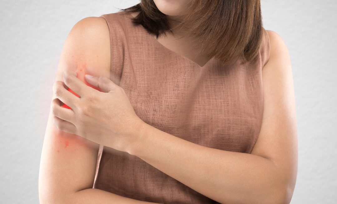 Person scratching their arm, representing discomfort from insect bites and the importance of learning about insect-borne diseases before travel.