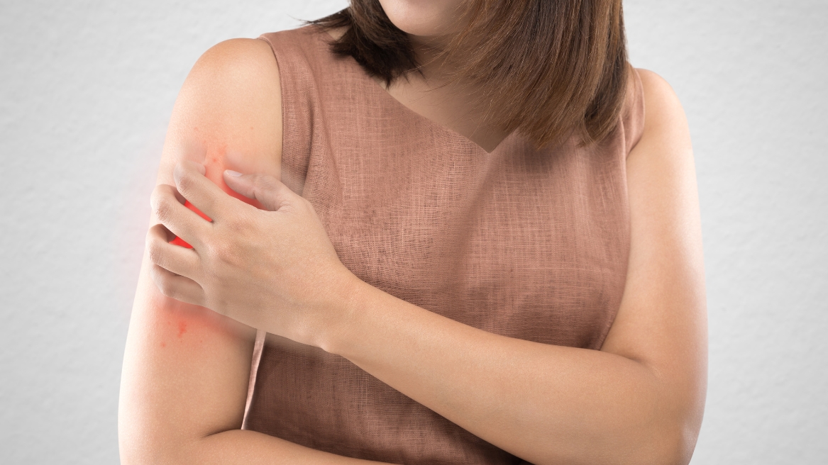 Person scratching their arm, representing discomfort from insect bites and the importance of learning about insect-borne diseases before travel.